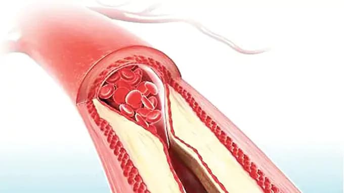 కొలెస్ట్రాల్ కి వేయండి కొత్తగా అడ్డుకట్ట